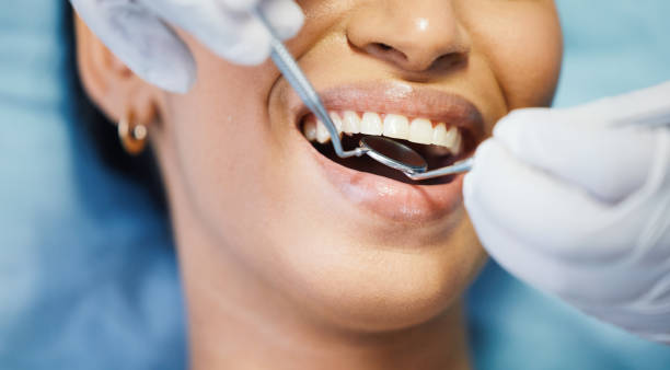 Best Emergency Wisdom Teeth Removal in Linden, TX