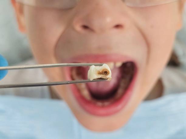 Best Emergency Tooth Extraction in Linden, TX